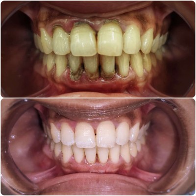 Smile makeover case with Dr. Alisha Prem