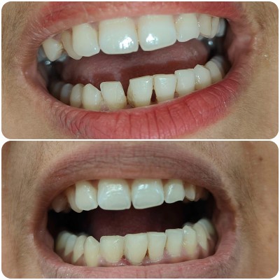 Aligner case with Dr. Alisha Prem
