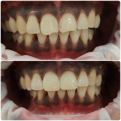 Veneers case with Dr. Alisha Prem